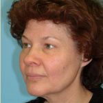 Blepharoplasty Before & After Patient #185