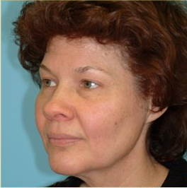 Blepharoplasty Before & After Patient #185