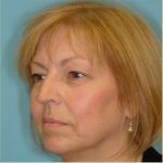 Blepharoplasty Before & After Patient #192