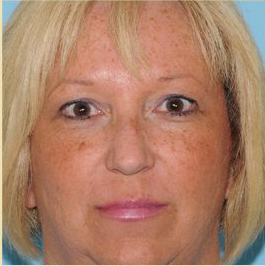 Blepharoplasty Before & After Patient #199