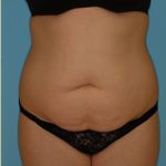 Abdominoplasty Before & After Patient #80