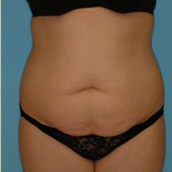 Abdominoplasty Before & After Patient #80
