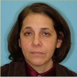 Facelift Before & After Patient #206