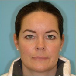 Blepharoplasty Before & After Patient #221