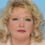 Facelift Before & After Patient #228