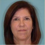 Facelift Before & After Patient #235