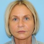 Facelift Before & After Patient #242