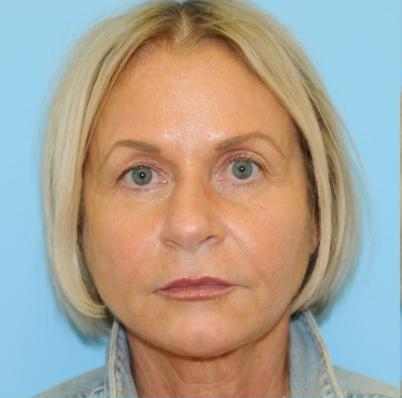 Facelift Before & After Patient #242