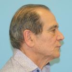 Facelift Before & After Patient #249