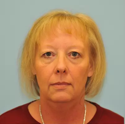 Facelift Before & After Patient #256