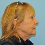 Facelift Before & After Patient #263