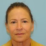 Facelift Before & After Patient #2766