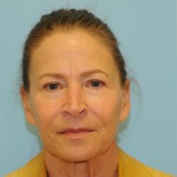 Facelift Before & After Patient #270