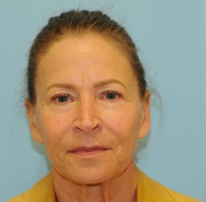 Facelift Before & After Patient #270
