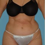 Abdominoplasty Before & After Patient #87