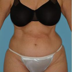 Abdominoplasty Before & After Patient #87