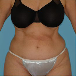 Abdominoplasty Before & After Patient #87