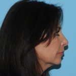 Facelift Before & After Patient #277