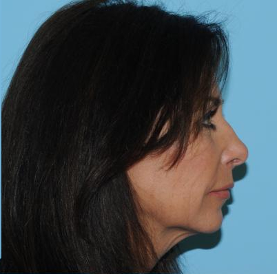 Facelift Before & After Patient #277