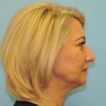 Facelift Before & After Patient #284