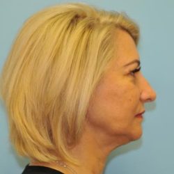 Facelift Before & After Patient #284