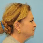 Facelift Before & After Patient #291