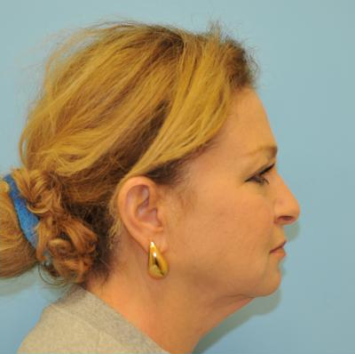 Facelift Before & After Patient #291