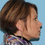Facelift Before & After Patient #298