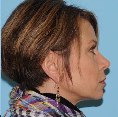 Facelift Before & After Patient #298