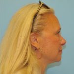 Blepharoplasty Before & After Patient #305