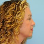 Blepharoplasty Before & After Patient #312
