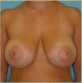 Breast Reduction Before & After Patient #333