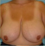 Breast Reduction Before & After Patient #340