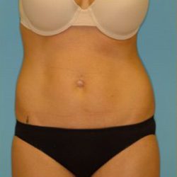 Abdominoplasty Before & After Patient #94