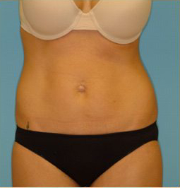 Abdominoplasty Before & After Patient #94