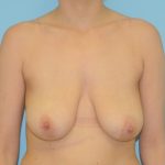 Breast Reduction Before & After Patient #368