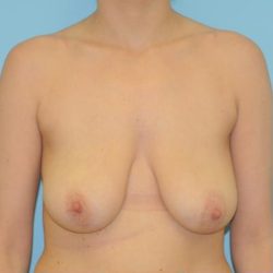 Breast Reduction Before & After Patient #368