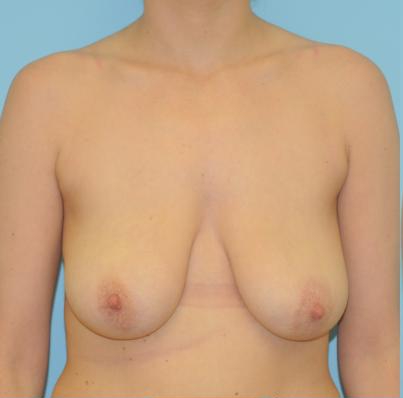 Breast Reduction Before & After Patient #368
