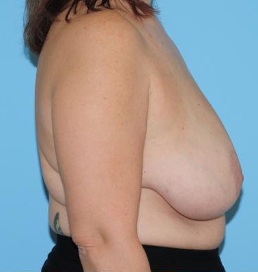 Breast Reduction Before & After Patient #382