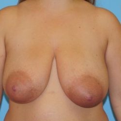 Breast Reduction Before & After Patient #389
