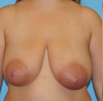 Breast Reduction Before & After Patient #389