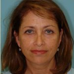 Facelift Before & After Patient #396