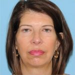 Facelift Before & After Patient #410