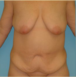 Abdominoplasty Before & After Patient #101
