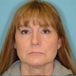 Facelift Before & After Patient #417