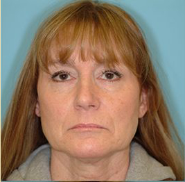 Facelift Before & After Patient #417