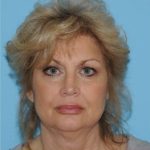 Facelift Before & After Patient #424