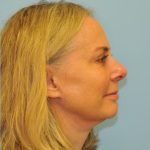 Facelift Before & After Patient #445