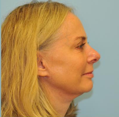 Facelift Before & After Patient #445