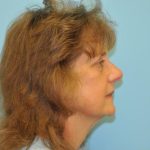 Facelift Before & After Patient #452
